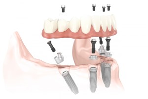 NobelProcera Implant Bridge on Multi-unit Abutments